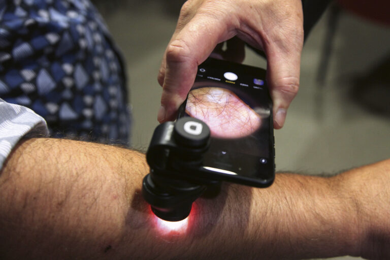 Grâce à un dispositif ajusté sur l’appareil photo, le smartphone se transforme en dermatoscope pour faciliter la télédermatologie.